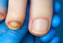 Czy można iść do podologa z grzybicą paznokci? Czy można iść do podolog z grzybica paznokci
