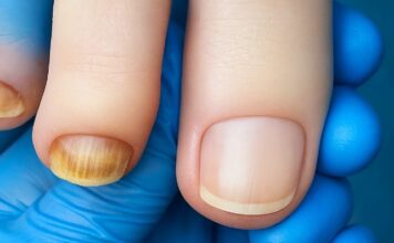 Czy można iść do podologa z grzybicą paznokci? Czy można iść do podolog z grzybica paznokci